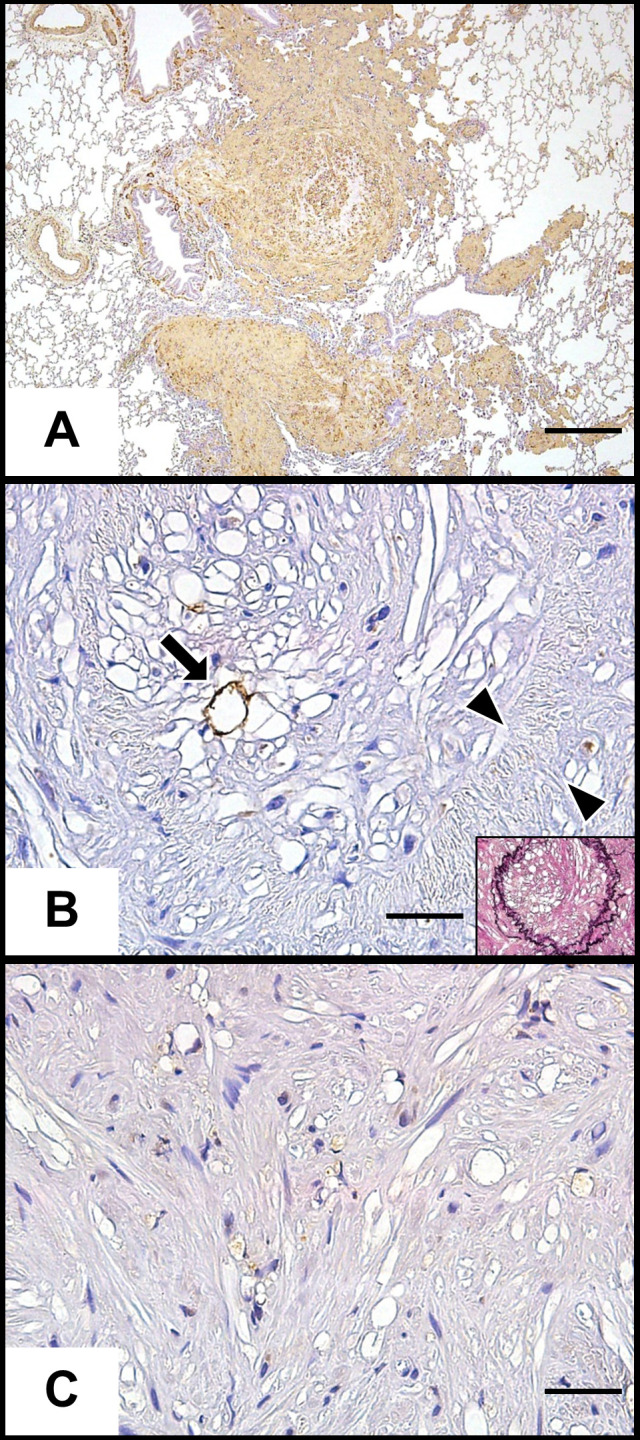 Smooth muscle hamartoma of the lungs in a Wistar Hannover rat.