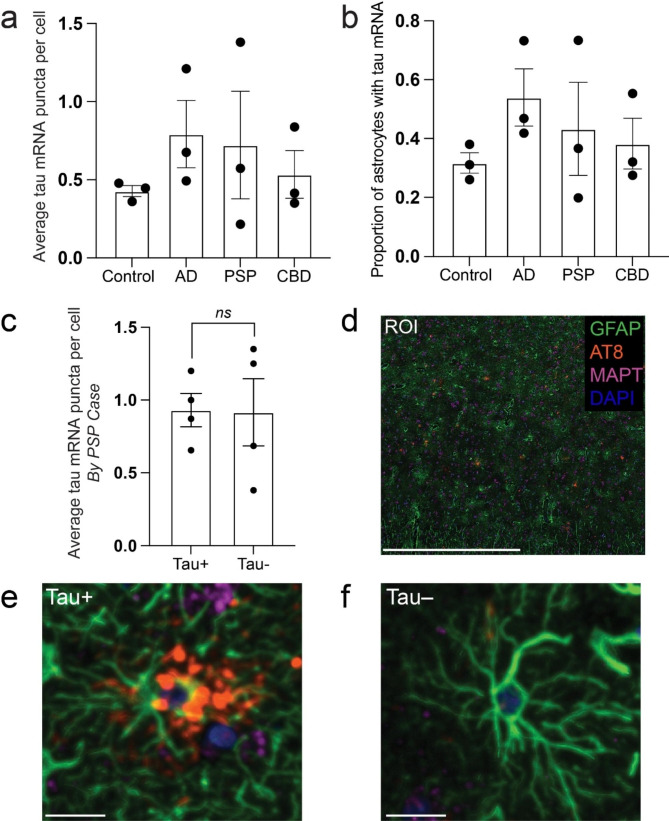 Determinants of astrocytic pathology in stem cell models of primary tauopathies.