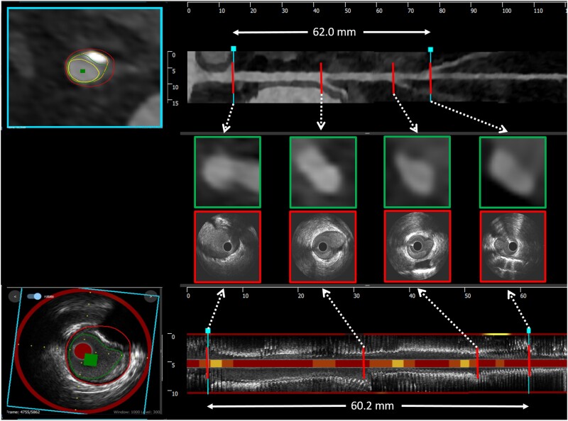 Novel near-infrared spectroscopy-intravascular ultrasound-based deep-learning methodology for accurate coronary computed tomography plaque quantification and characterization.