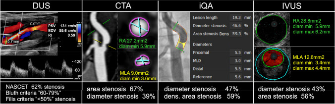 Imaging modality-dependent carotid stenosis severity variations against intravascular ultrasound as a reference: Carotid Artery intravasculaR Ultrasound Study (CARUS).