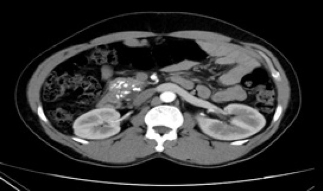 Advancing Treatment Frontiers: Radiofrequency Ablation for Small Renal Mass-Intermediate-Term Results.