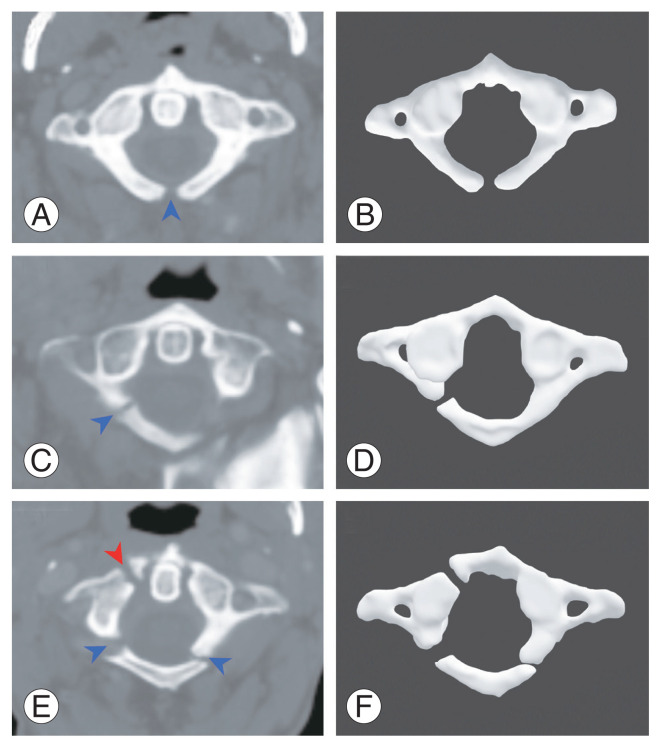 Radiological Study of Atlas Arch Defects with Meta-Analysis and a Proposed New Classification.