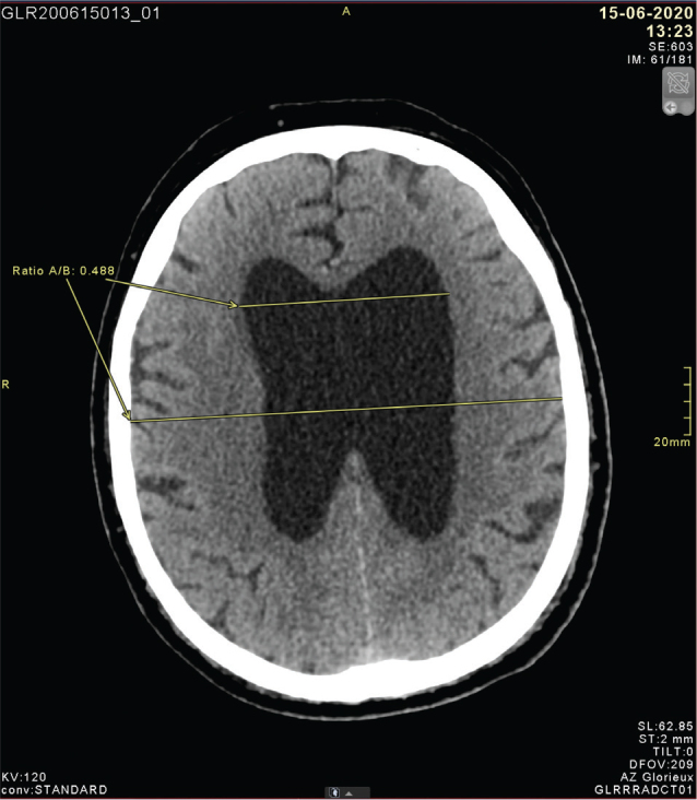 CASE REPORT OF IDIOPATHIC NORMAL PRESSURE HYDROCEPHALUS: A CHALLENGING DIAGNOSIS.