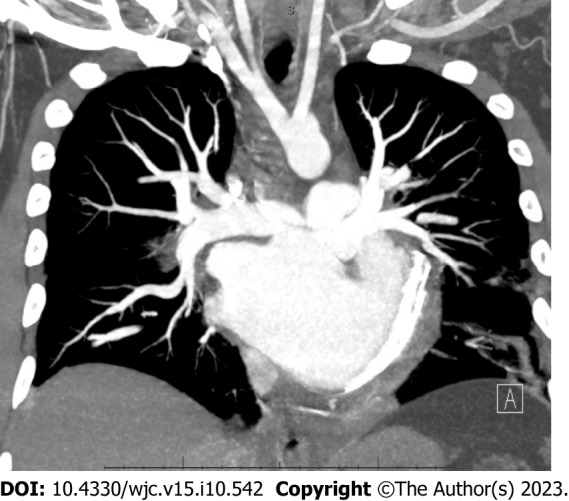 Systemic right ventricle complications in levo-transposition of the great arteries: A case report and review of literature.