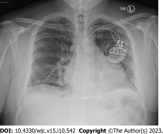 Systemic right ventricle complications in levo-transposition of the great arteries: A case report and review of literature.