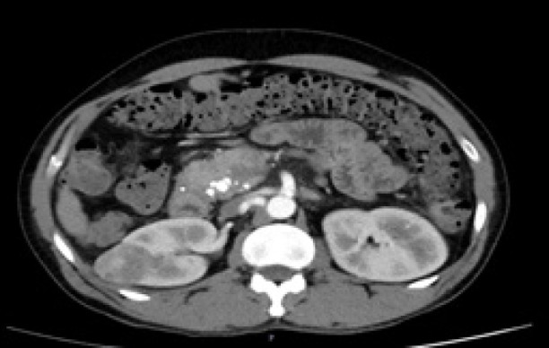 Advancing Treatment Frontiers: Radiofrequency Ablation for Small Renal Mass-Intermediate-Term Results.