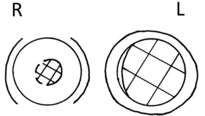 Distribution of cup-disc ratio in a Swedish population.