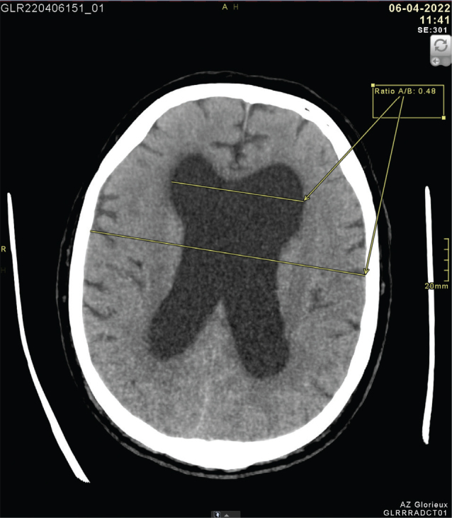 CASE REPORT OF IDIOPATHIC NORMAL PRESSURE HYDROCEPHALUS: A CHALLENGING DIAGNOSIS.