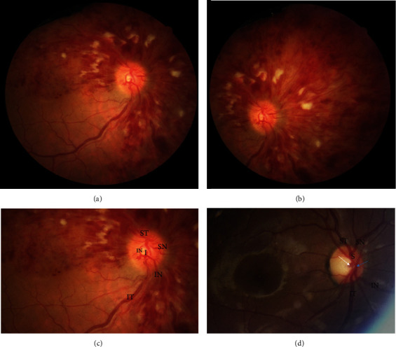 Central Retinal Vein Occlusion with Three-Retinal Quadrant Involvement: Another Focus on Optic Disc Head Vascular Anatomy Variations.