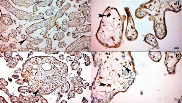 Severe preeclampsia complicated by HELLP syndrome alters the structure of Hofbauer and syncytiotrophoblast cells: ultrastructural and immunohistochemical study.