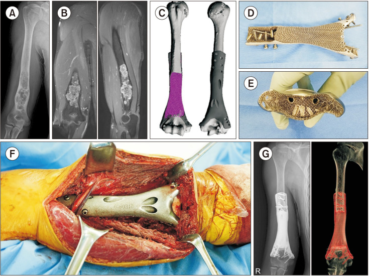 Whole Blood Titanium Concentration after Limb Salvage Surgery with Three-Dimensional-Printed Ti6Al4V Implants.