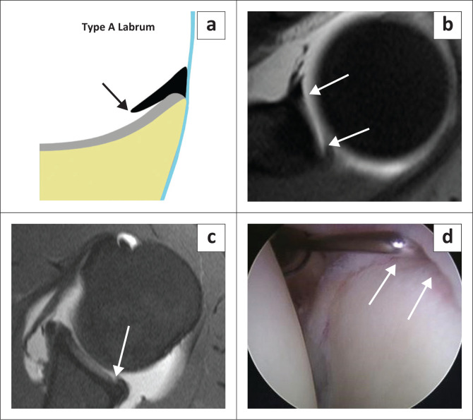 Superior labrum anterior to posterior lesions: Part 1 - Imaging and anatomy with arthroscopic classification.