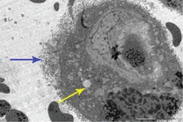 Severe preeclampsia complicated by HELLP syndrome alters the structure of Hofbauer and syncytiotrophoblast cells: ultrastructural and immunohistochemical study.