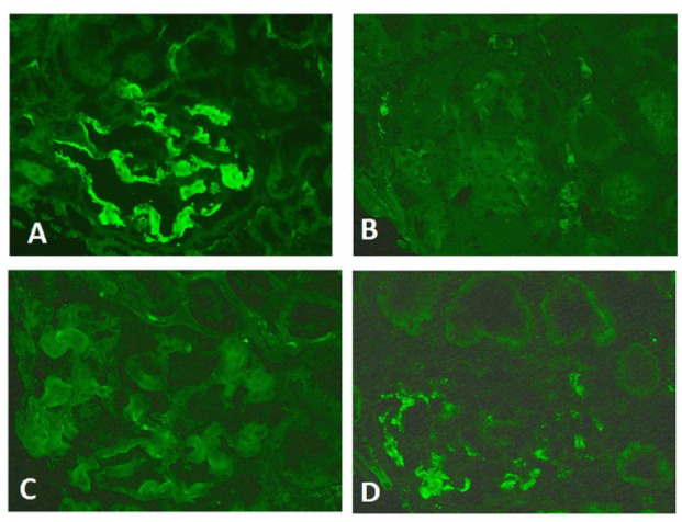 De Novo Fibrinogen A Alpha Chain Amyloidosis in a Kidney Transplant Patient: Case Report and Literature Review.