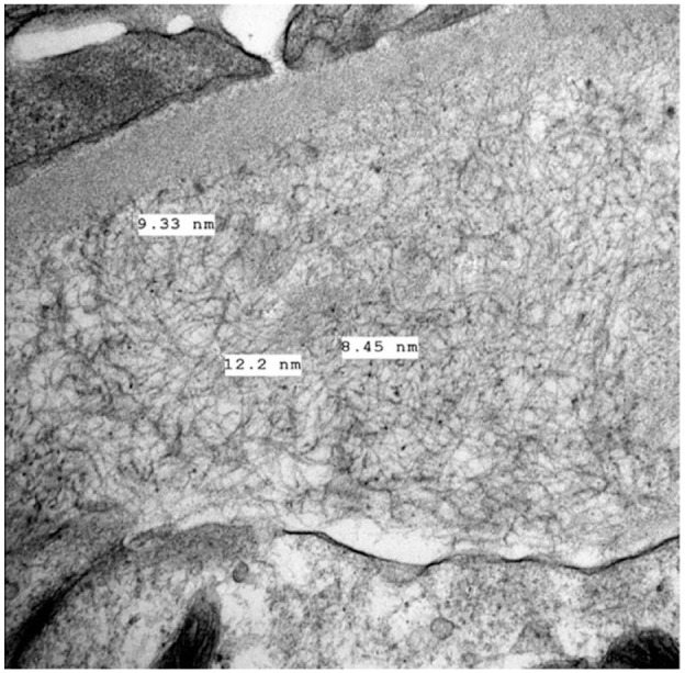 De Novo Fibrinogen A Alpha Chain Amyloidosis in a Kidney Transplant Patient: Case Report and Literature Review.