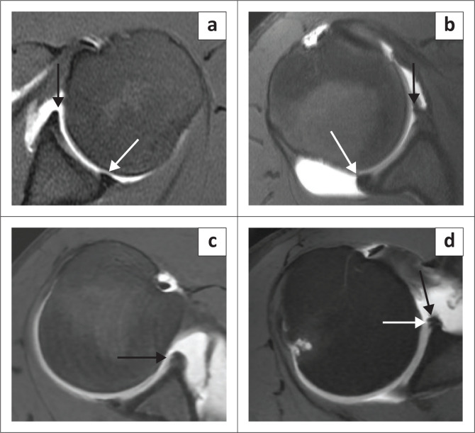 Superior labrum anterior to posterior lesions: Part 1 - Imaging and anatomy with arthroscopic classification.