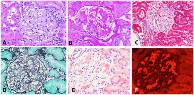 De Novo Fibrinogen A Alpha Chain Amyloidosis in a Kidney Transplant Patient: Case Report and Literature Review.