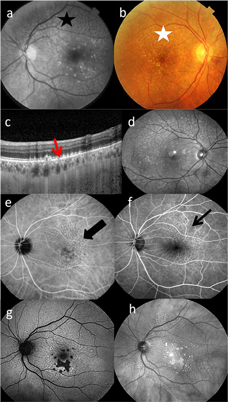 Multimodal Imaging of Reticular Pseudodrusen in Turkish Patients.