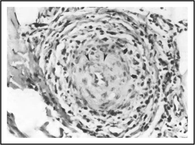 Systemic vasculitis and headache.