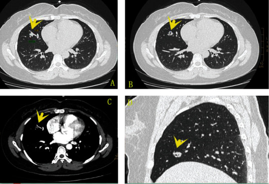 Clinicopathological Analysis of Bronchiolar Adenoma Lined Purely by Mucinous Luminal Cells.