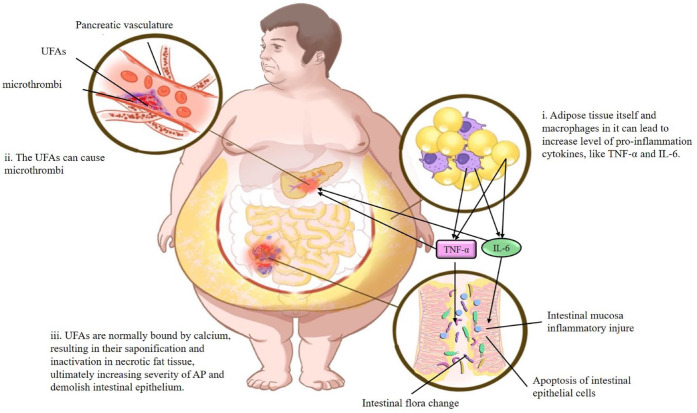 Gut microbiota interacts with inflammatory responses in acute pancreatitis.