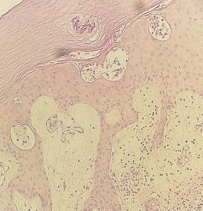 Intravenous Immunoglobulin Therapy-Induced Erythema Multiforme in a Patient with Chronic Lymphocytic Leukemia.