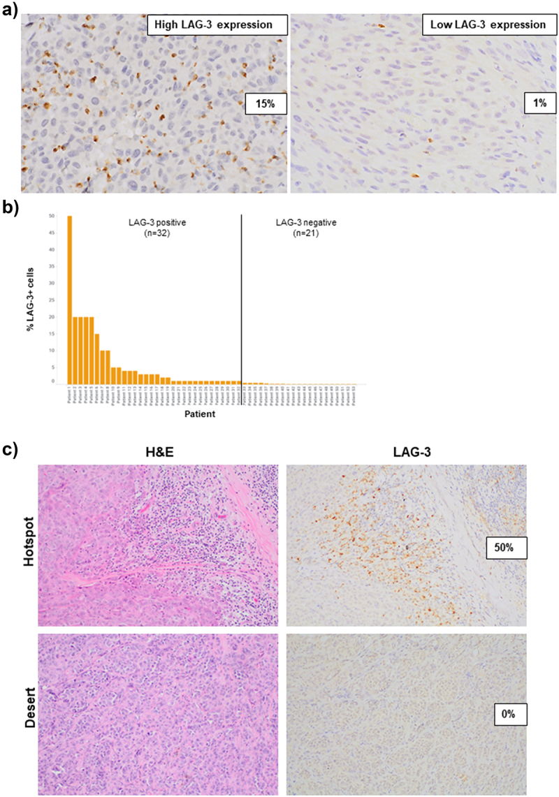 Lag-3 expression and clinical outcomes in metastatic melanoma patients treated with combination anti-lag-3 + anti-PD-1-based immunotherapies.