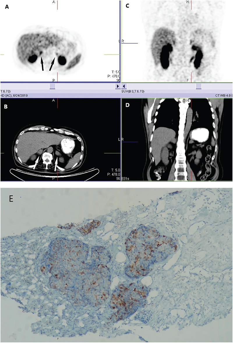 Isolated Castrate-resistant Prostate Cancer Metastasis to Both Adrenal Glands Detected on <sup>68</sup>Ga PSMA PET/CT.