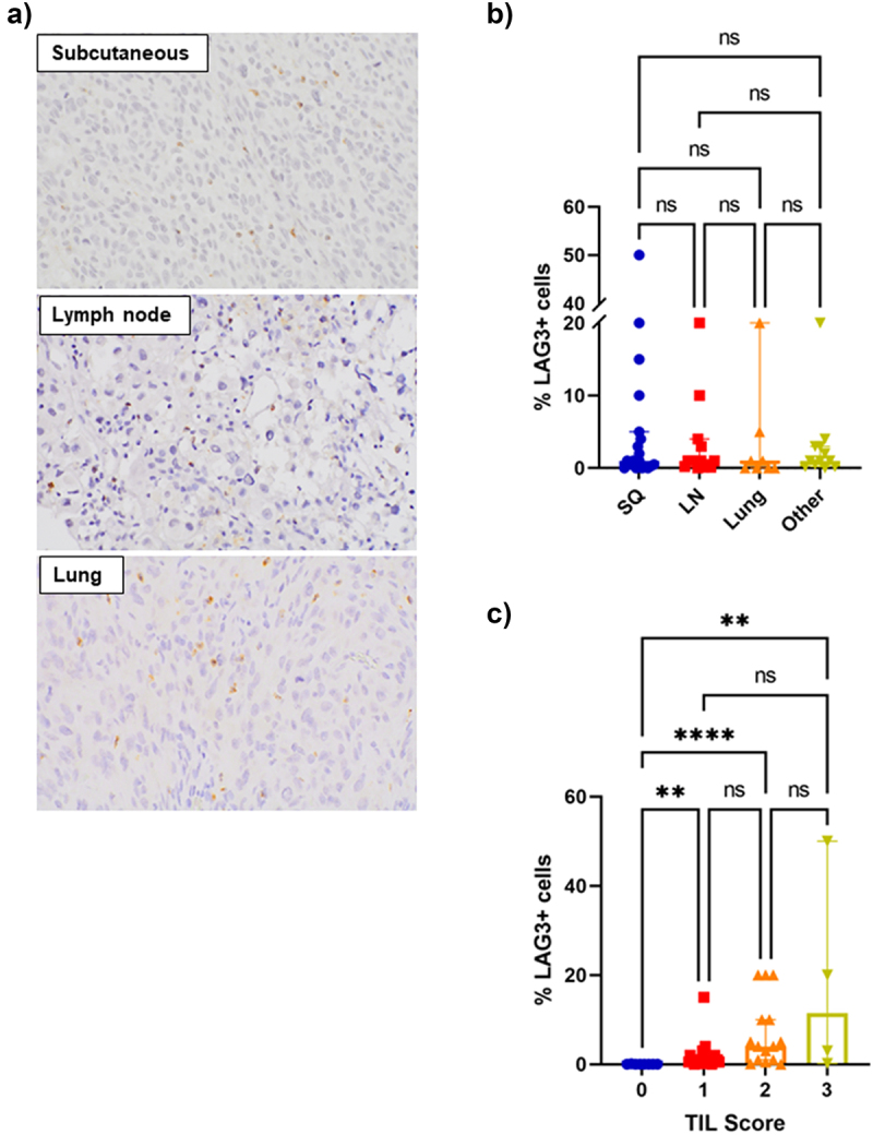 Lag-3 expression and clinical outcomes in metastatic melanoma patients treated with combination anti-lag-3 + anti-PD-1-based immunotherapies.