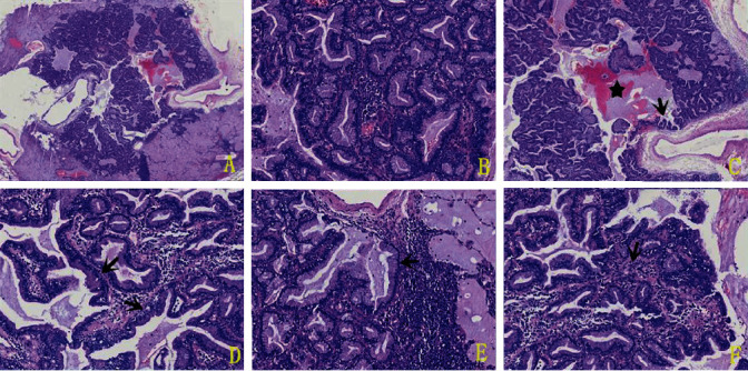 Clinicopathological Analysis of Bronchiolar Adenoma Lined Purely by Mucinous Luminal Cells.