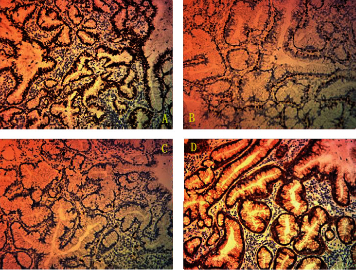 Clinicopathological Analysis of Bronchiolar Adenoma Lined Purely by Mucinous Luminal Cells.