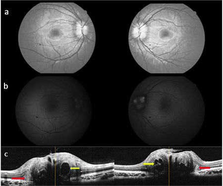 Clinical Findings and Optical Coherence Tomography Measurements of Pediatric Patients with Papilledema and Pseudopapilledema.