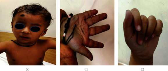 A Rare Case of Mosaic 3pter and 5pter Deletion-Duplication with Autism Spectrum Disorder and Dyskinesia.