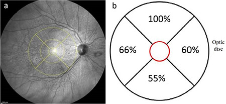 Multimodal Imaging of Reticular Pseudodrusen in Turkish Patients.