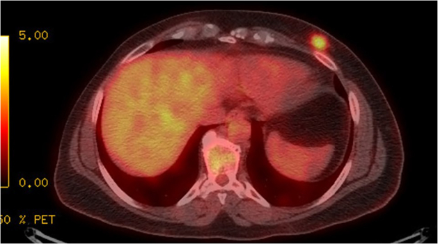 Implications of a Supernumerary Nipple Breast Cancer in a BReast CAncer Sequence Variation Carrier: A Case Report