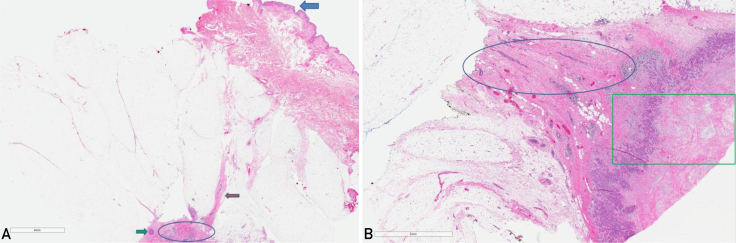 Implications of a Supernumerary Nipple Breast Cancer in a BReast CAncer Sequence Variation Carrier: A Case Report