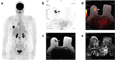 Relationship Between Metabolic Activity, Cellularity, Histopathological Features of Primary Tumors and Distant Metastatic Potential in Breast Cancer.