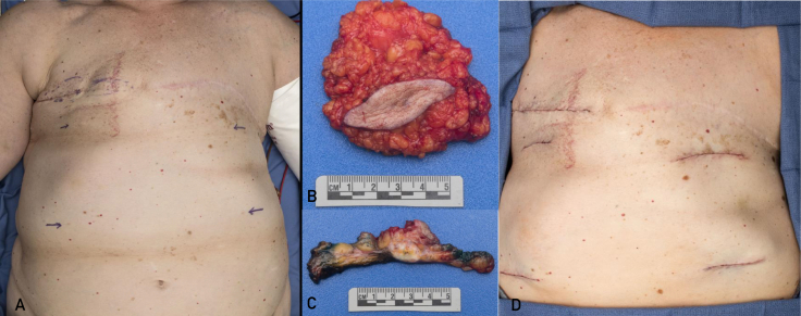 Implications of a Supernumerary Nipple Breast Cancer in a BReast CAncer Sequence Variation Carrier: A Case Report