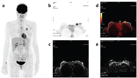 Relationship Between Metabolic Activity, Cellularity, Histopathological Features of Primary Tumors and Distant Metastatic Potential in Breast Cancer.