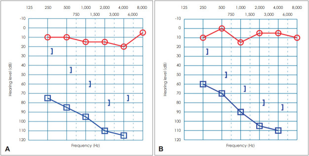 Selective Unilateral Inner Hair Cell Injury: A Case Report.