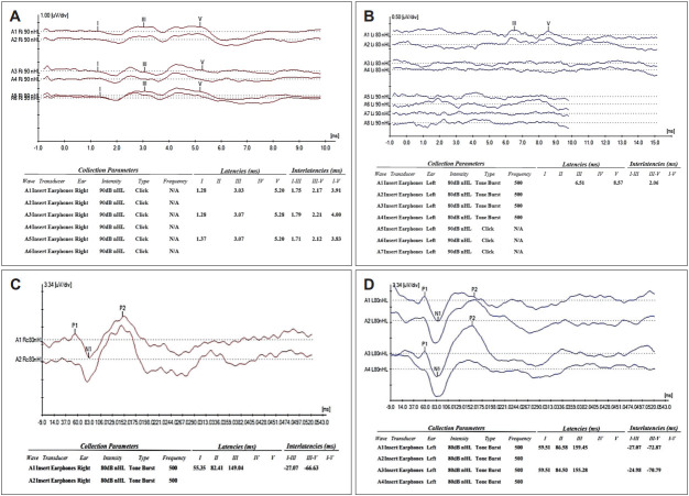 Selective Unilateral Inner Hair Cell Injury: A Case Report.