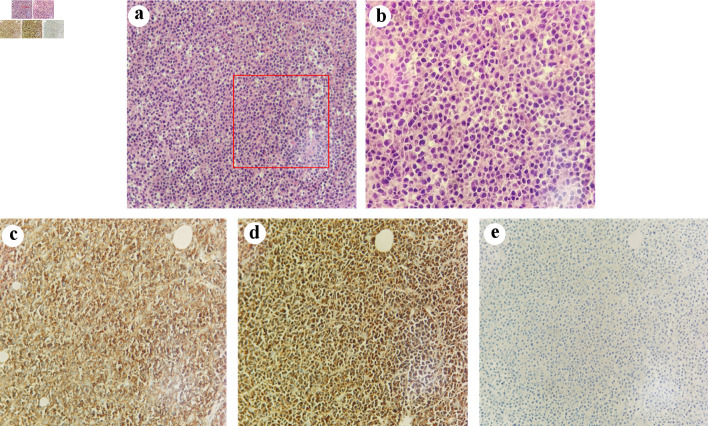 Multiple Myeloma Rather Than Metastatic Lung Cancer: An Unexpected Cause of Spinal Cord Compression.