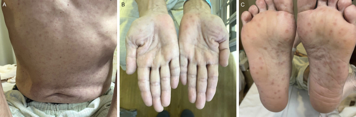 Secondary Syphilis Rash.