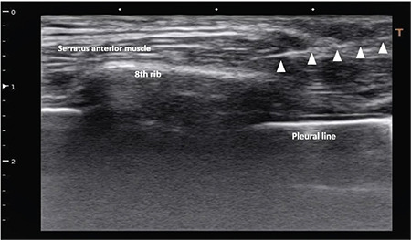 Continuous Serratus - Intercostal Plane Block for Perioperative Analgesia in Upper Abdominal Surgeries: A Prospective Randomized Controlled Study.