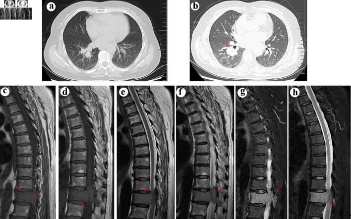 Multiple Myeloma Rather Than Metastatic Lung Cancer: An Unexpected Cause of Spinal Cord Compression.