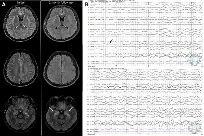 A case of hyperacute postvaccinal encephalopathy after BNT162b2 nCoV-19 vaccine.
