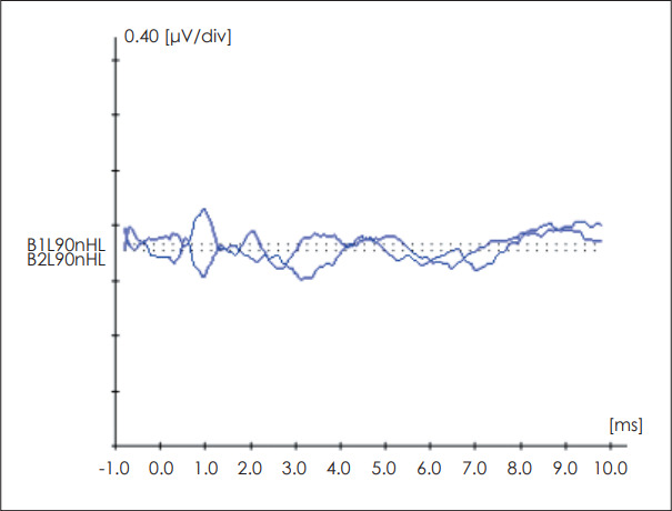 Selective Unilateral Inner Hair Cell Injury: A Case Report.