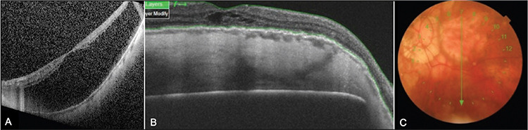 Management of Myopic Maculopathy: A Review.