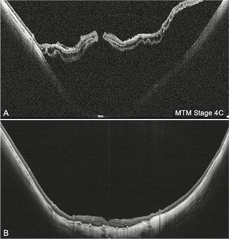 Management of Myopic Maculopathy: A Review.