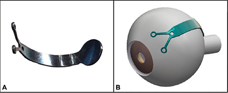 Management of Myopic Maculopathy: A Review.